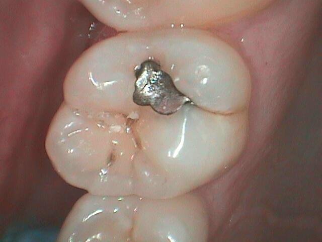 3 OL Before