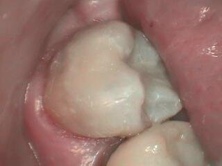 31 after