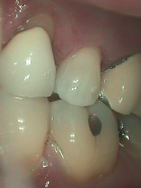 composite after from cheekside