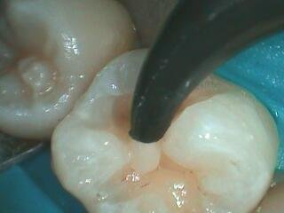 Intra-Oral_05-29-14_0003 Bevel Example